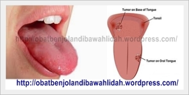 obat benjolan di bawah lidah